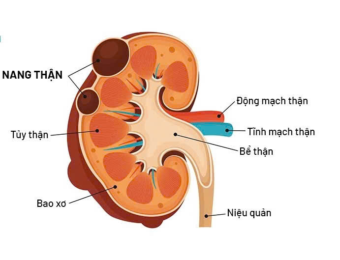 Nỗi lo về Nang thận