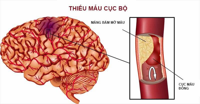 Thiếu máu não cục bộ và nhồi máu não | Phòng khám Bình Minh