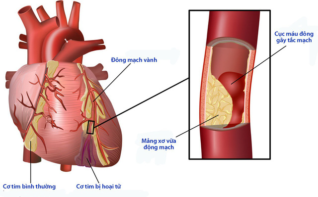 Bệnh tim mạch và bệnh đái tháo đường có mối liên hệ như thế nào?