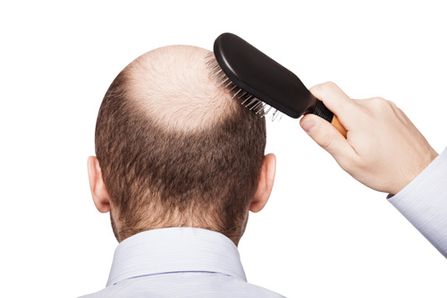 Phương pháp mới trị chứng hói đầu và rụng tóc